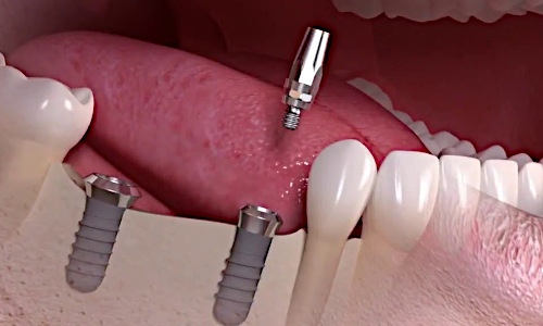 Для кого подходят зубные имплантаты?