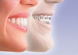 Invisalign в стоматологической клинике Генри Кларка