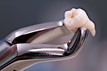Спасём зубы от удаления