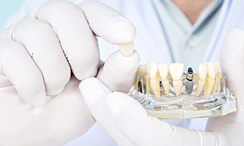 Зубное протезирование.Коронки